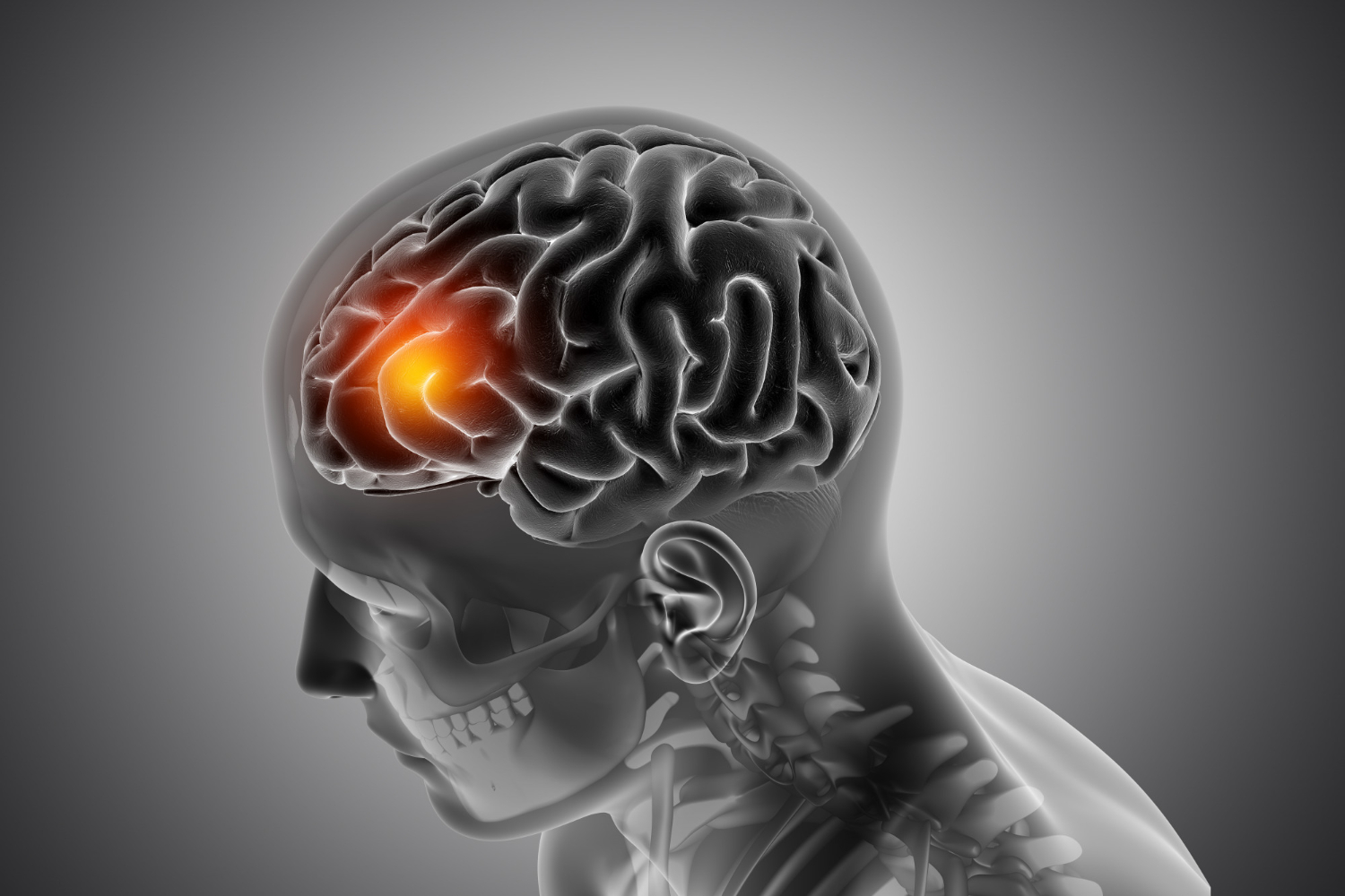 Cranial and spine tumour