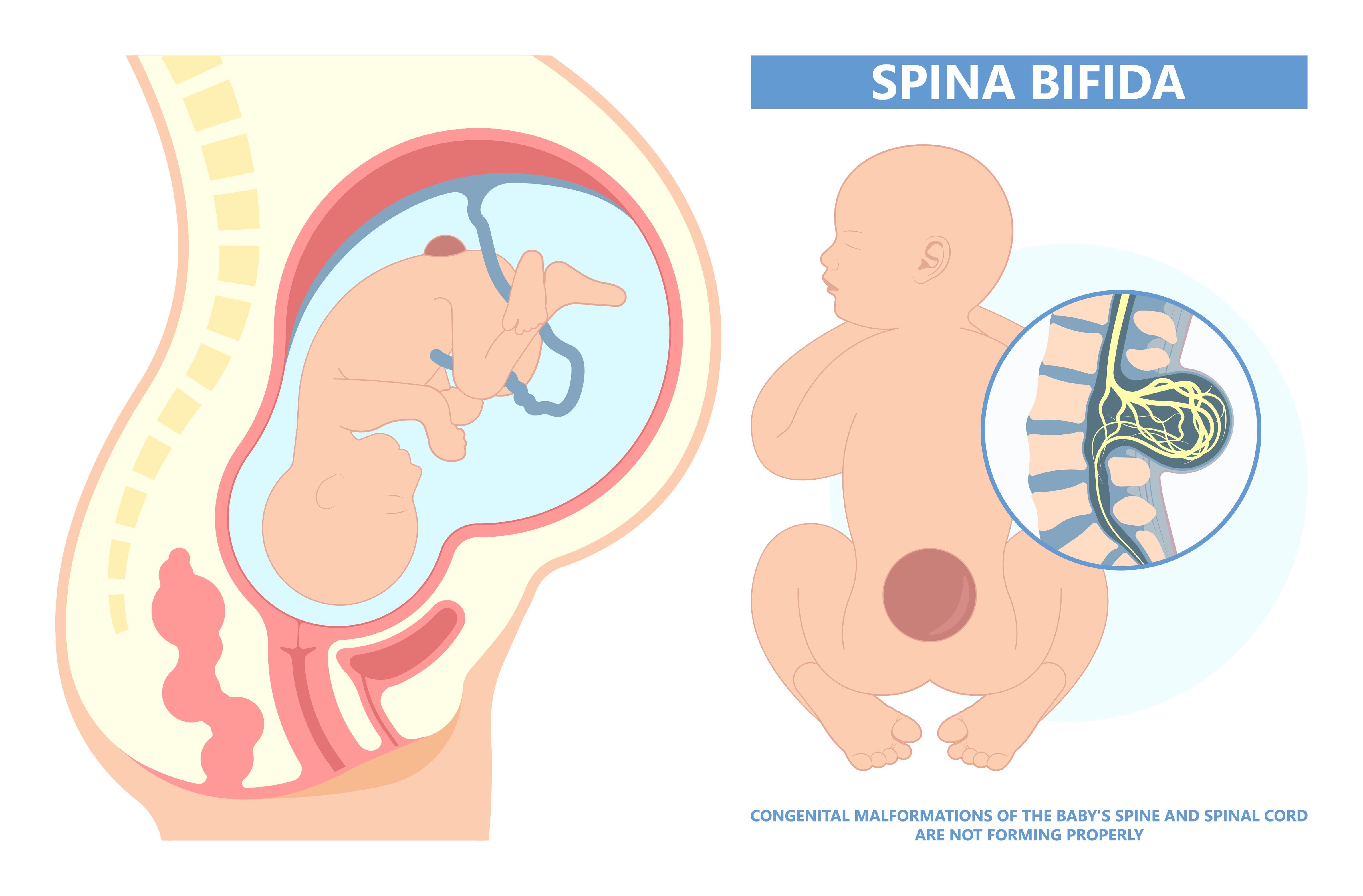 Spinal Dysraphisms